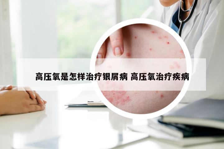高压氧是怎样治疗银屑病 高压氧治疗疾病