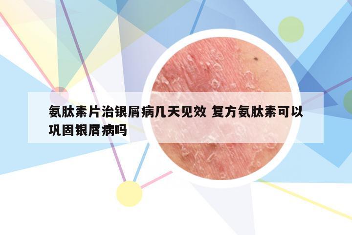 氨肽素片治银屑病几天见效 复方氨肽素可以巩固银屑病吗
