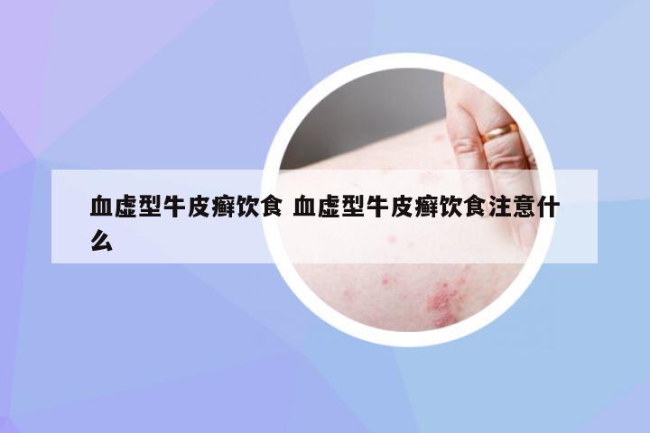 血虚型牛皮癣饮食 血虚型牛皮癣饮食注意什么