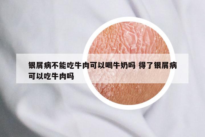 银屑病不能吃牛肉可以喝牛奶吗 得了银屑病可以吃牛肉吗