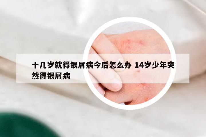 十几岁就得银屑病今后怎么办 14岁少年突然得银屑病