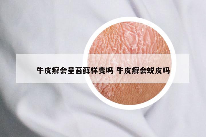 牛皮癣会呈苔藓样变吗 牛皮癣会蜕皮吗