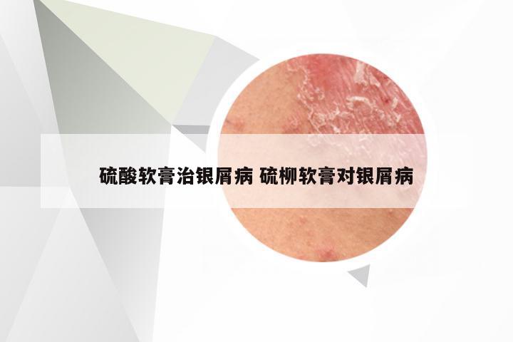 硫酸软膏治银屑病 硫柳软膏对银屑病