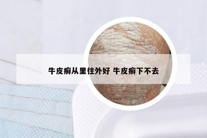 牛皮癣从里往外好 牛皮癣下不去