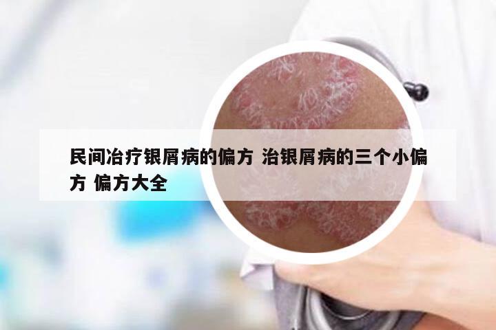 民间冶疗银屑病的偏方 治银屑病的三个小偏方 偏方大全