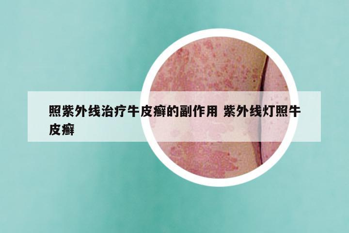 照紫外线治疗牛皮癣的副作用 紫外线灯照牛皮癣