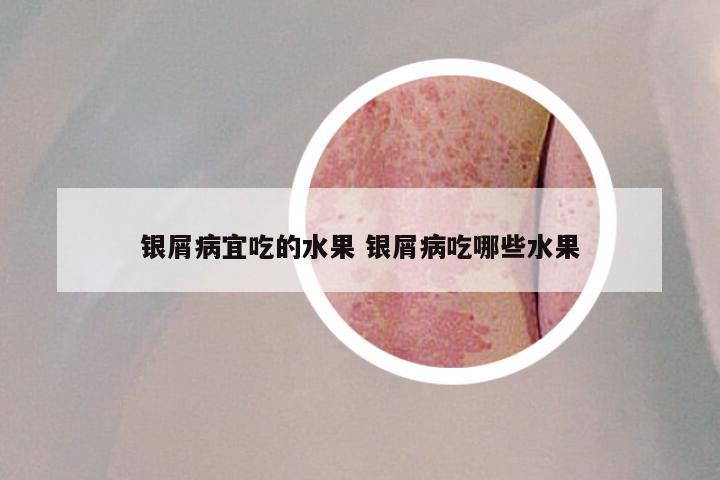 银屑病宜吃的水果 银屑病吃哪些水果