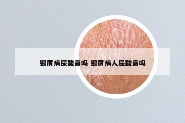 银屑病尿酸高吗 银屑病人尿酸高吗