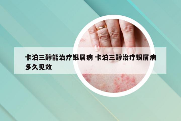 卡泊三醇能治疗银屑病 卡泊三醇治疗银屑病多久见效
