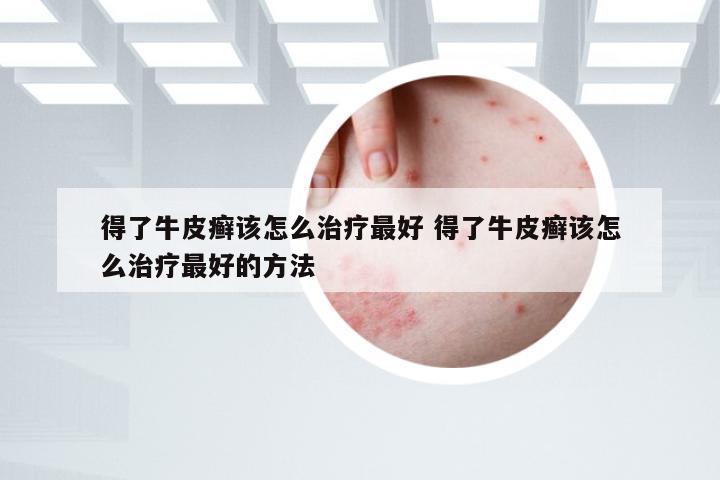 得了牛皮癣该怎么治疗最好 得了牛皮癣该怎么治疗最好的方法