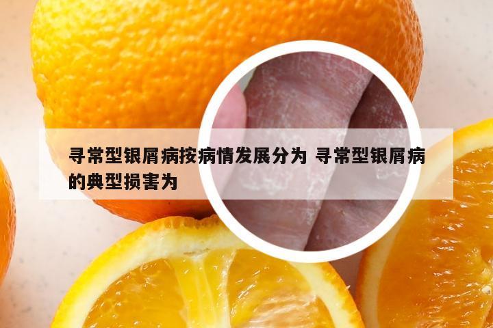 寻常型银屑病按病情发展分为 寻常型银屑病的典型损害为