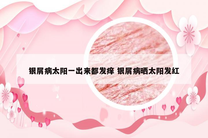 银屑病太阳一出来都发痒 银屑病晒太阳发红