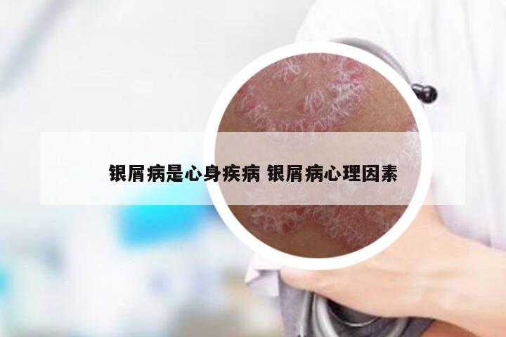 银屑病是心身疾病 银屑病心理因素