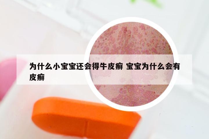 为什么小宝宝还会得牛皮癣 宝宝为什么会有皮癣