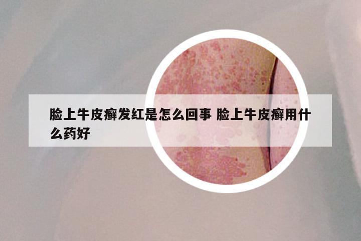 脸上牛皮癣发红是怎么回事 脸上牛皮癣用什么药好