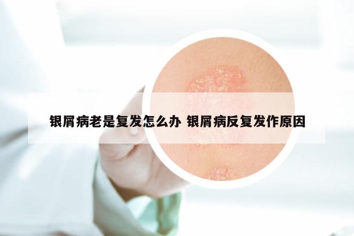 银屑病老是复发怎么办 银屑病反复发作原因