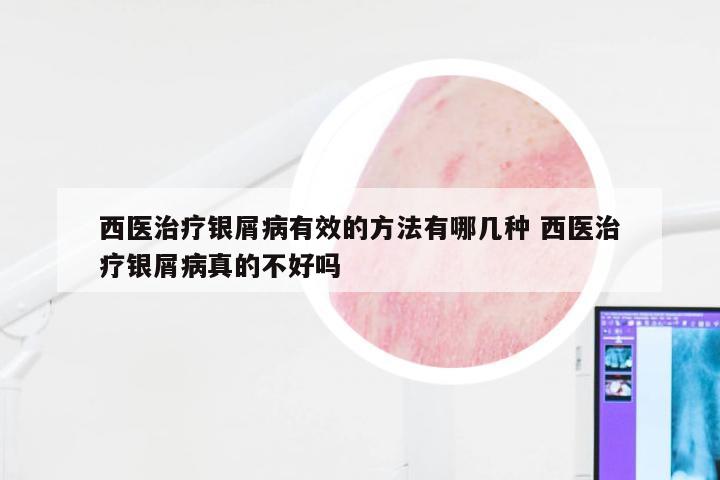 西医治疗银屑病有效的方法有哪几种 西医治疗银屑病真的不好吗
