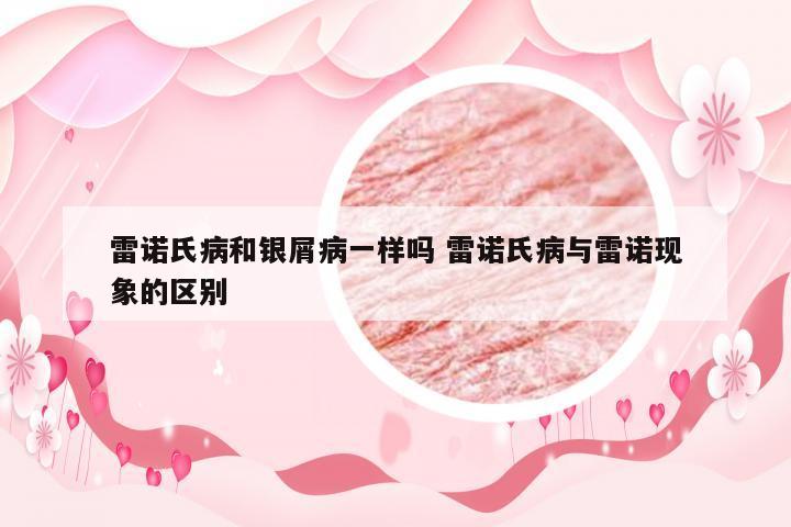 雷诺氏病和银屑病一样吗 雷诺氏病与雷诺现象的区别