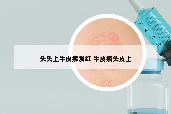 头头上牛皮癣发红 牛皮癣头皮上