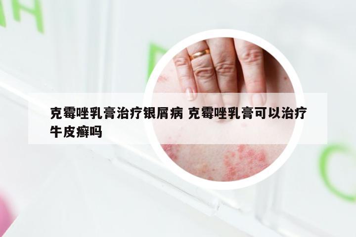 克霉唑乳膏治疗银屑病 克霉唑乳膏可以治疗牛皮癣吗