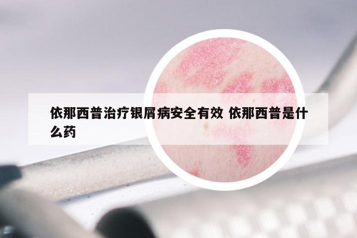 依那西普治疗银屑病安全有效 依那西普是什么药