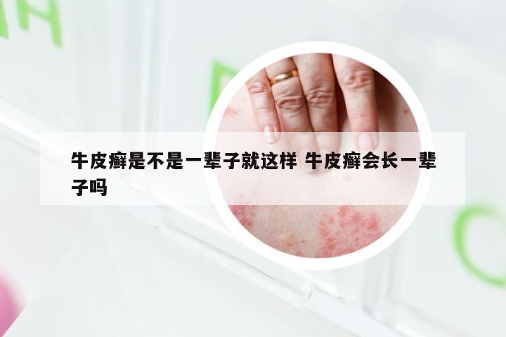 牛皮癣是不是一辈子就这样 牛皮癣会长一辈子吗