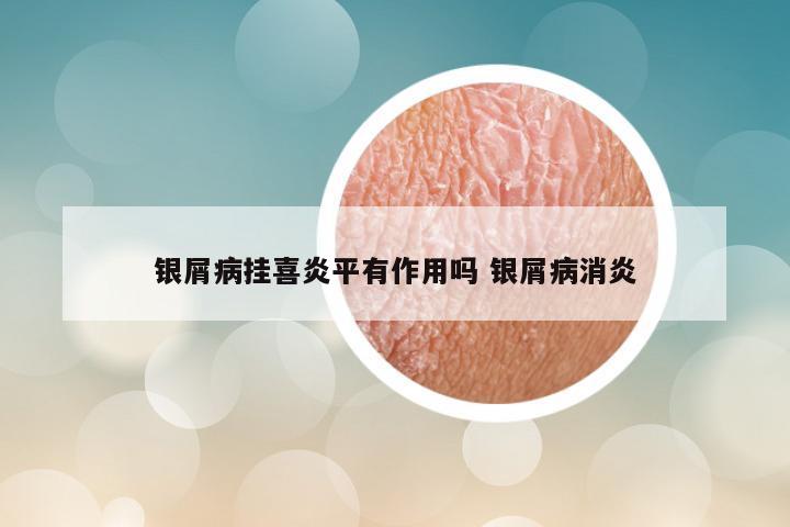 银屑病挂喜炎平有作用吗 银屑病消炎