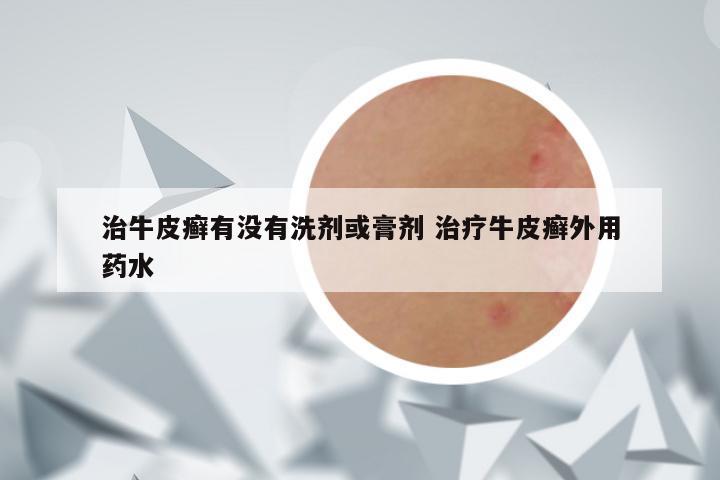 治牛皮癣有没有洗剂或膏剂 治疗牛皮癣外用药水