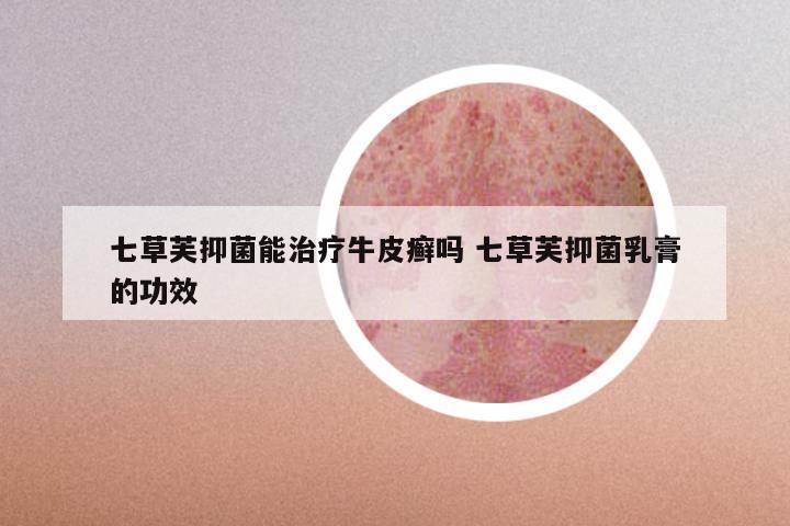 七草芙抑菌能治疗牛皮癣吗 七草芙抑菌乳膏的功效