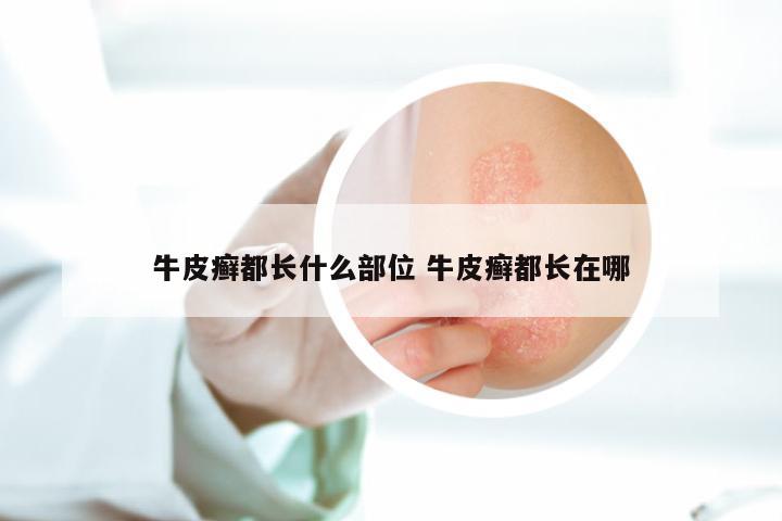 牛皮癣都长什么部位 牛皮癣都长在哪