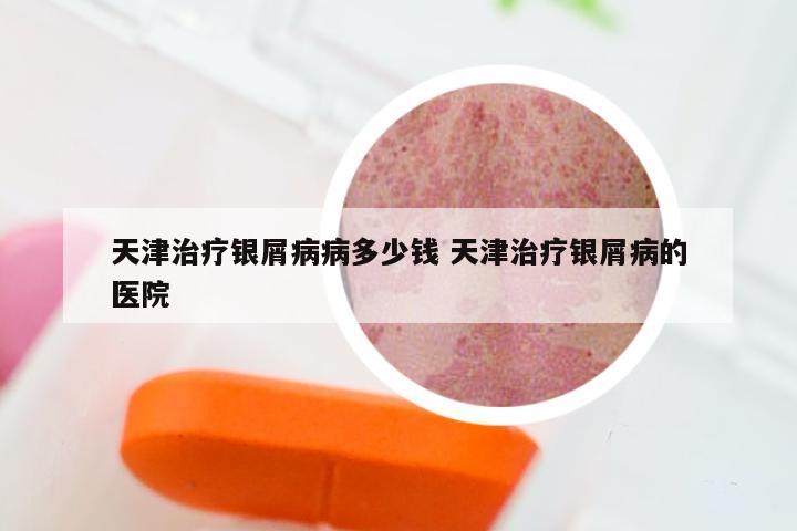 天津治疗银屑病病多少钱 天津治疗银屑病的医院