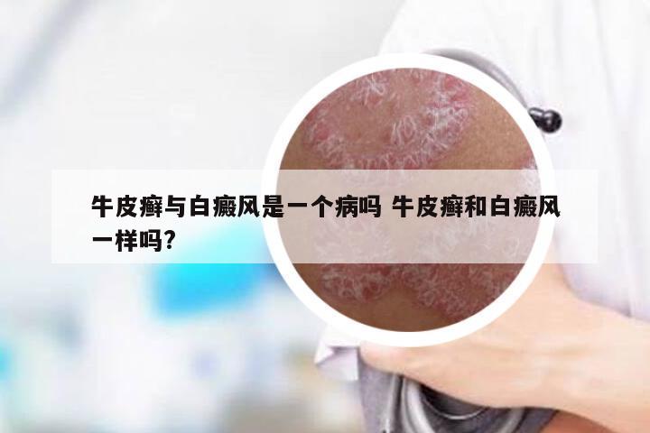 牛皮癣与白癜风是一个病吗 牛皮癣和白癜风一样吗?