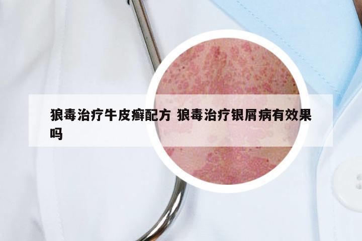 狼毒治疗牛皮癣配方 狼毒治疗银屑病有效果吗