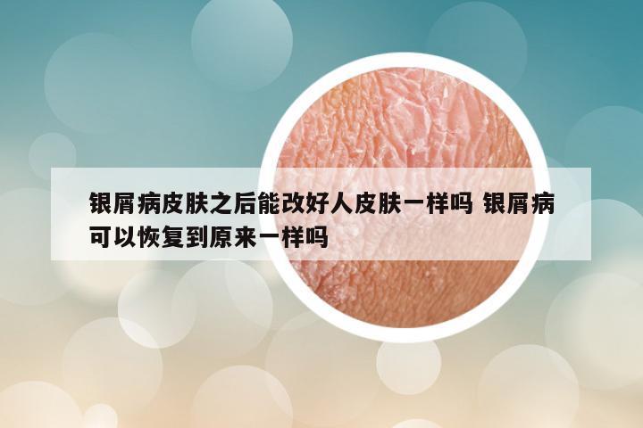 银屑病皮肤之后能改好人皮肤一样吗 银屑病可以恢复到原来一样吗