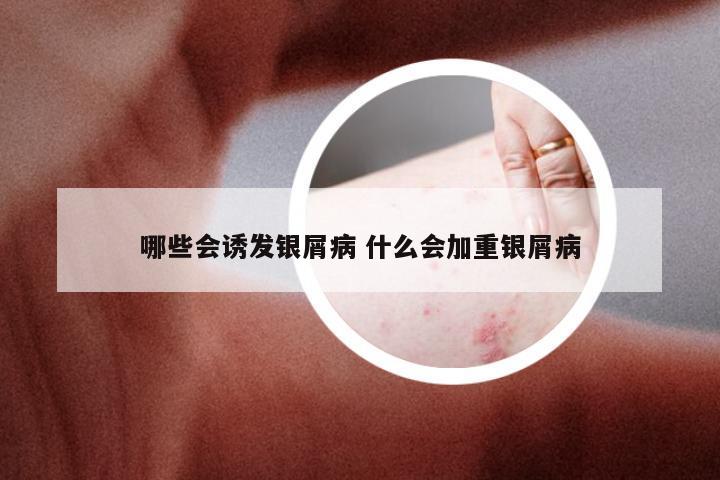 哪些会诱发银屑病 什么会加重银屑病