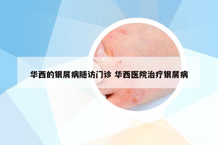 华西的银屑病随访门诊 华西医院治疗银屑病