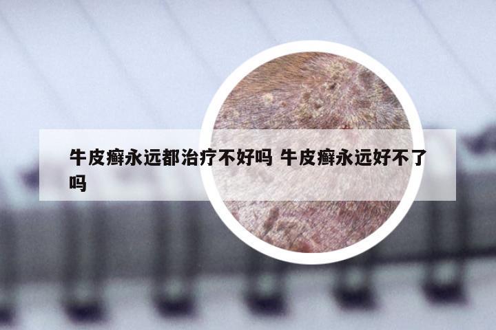牛皮癣永远都治疗不好吗 牛皮癣永远好不了吗
