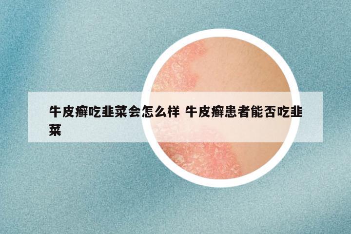 牛皮癣吃韭菜会怎么样 牛皮癣患者能否吃韭菜