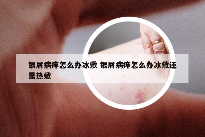 银屑病痒怎么办冰敷 银屑病痒怎么办冰敷还是热敷