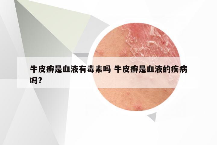 牛皮癣是血液有毒素吗 牛皮癣是血液的疾病吗?