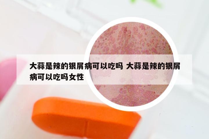 大蒜是辣的银屑病可以吃吗 大蒜是辣的银屑病可以吃吗女性