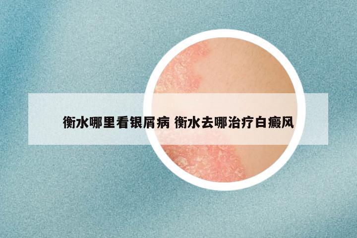 衡水哪里看银屑病 衡水去哪治疗白癜风