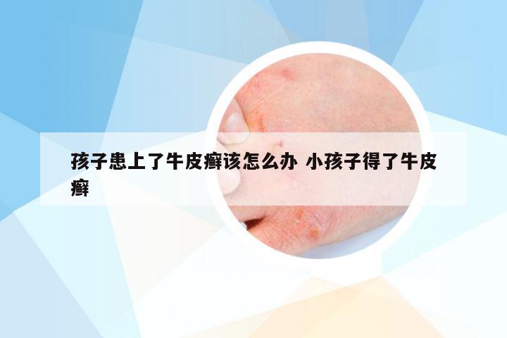 孩子患上了牛皮癣该怎么办 小孩子得了牛皮癣