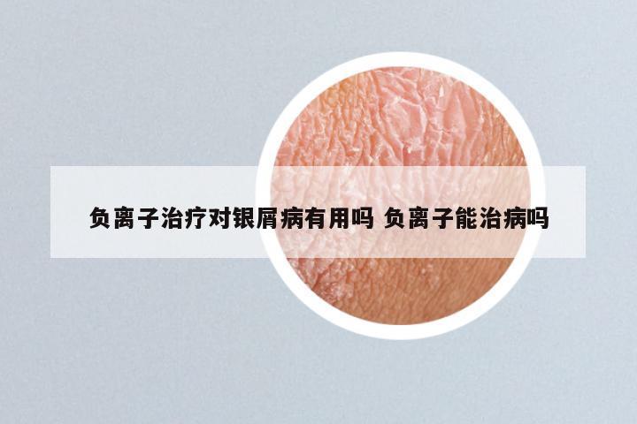 负离子治疗对银屑病有用吗 负离子能治病吗