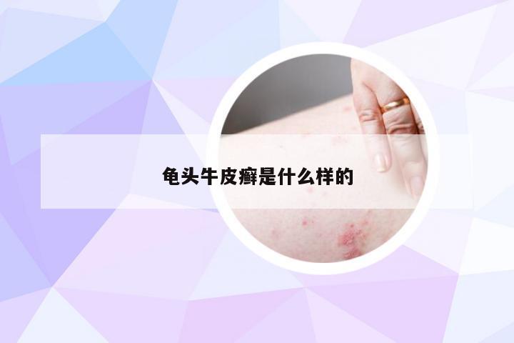 龟头牛皮癣是什么样的