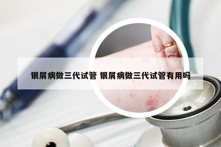 银屑病做三代试管 银屑病做三代试管有用吗