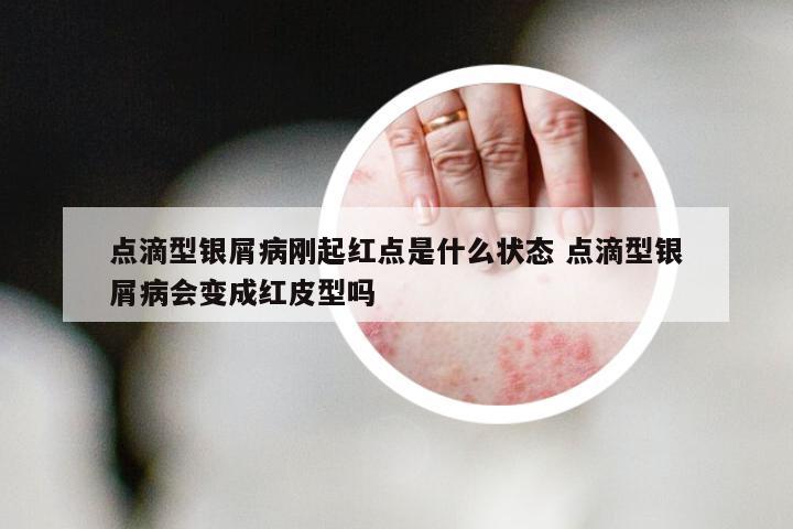点滴型银屑病刚起红点是什么状态 点滴型银屑病会变成红皮型吗
