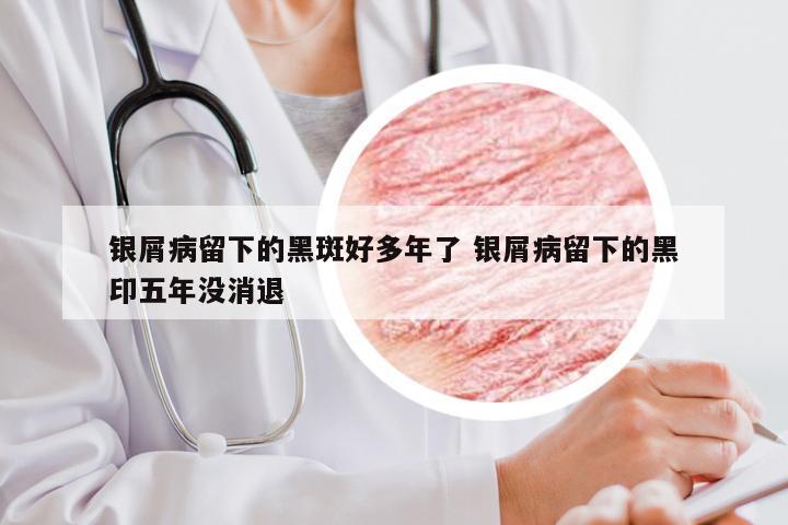 银屑病留下的黑斑好多年了 银屑病留下的黑印五年没消退