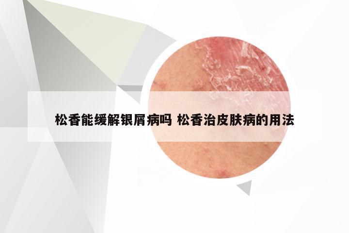 松香能缓解银屑病吗 松香治皮肤病的用法