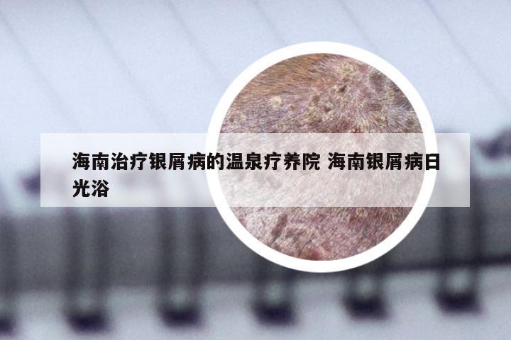 海南治疗银屑病的温泉疗养院 海南银屑病日光浴